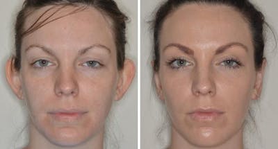 Otoplasty before and after, frontal.