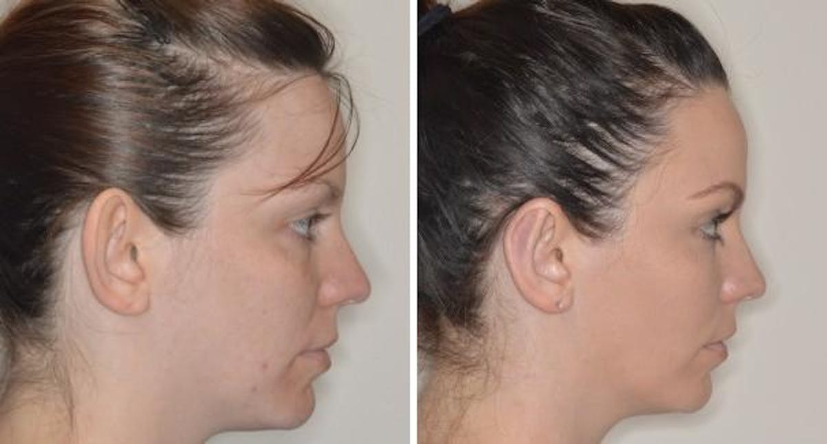 Otoplasty before and after, lateral right.