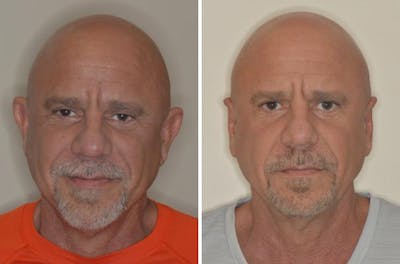Otoplasty before and after, frontal.