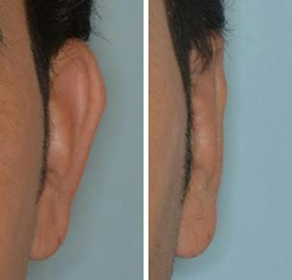 Otoplasty before and after, frontal. Frontal view of the left ear.