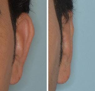 Otoplasty before and after, frontal. Frontal view of the left ear.