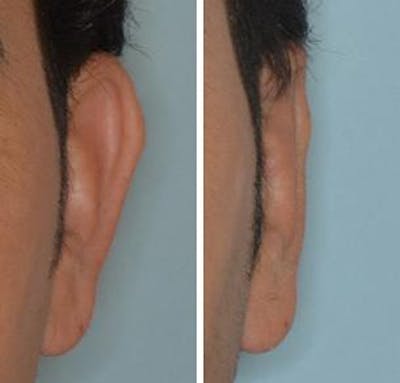 Otoplasty before and after, frontal. Frontal view of the left ear.