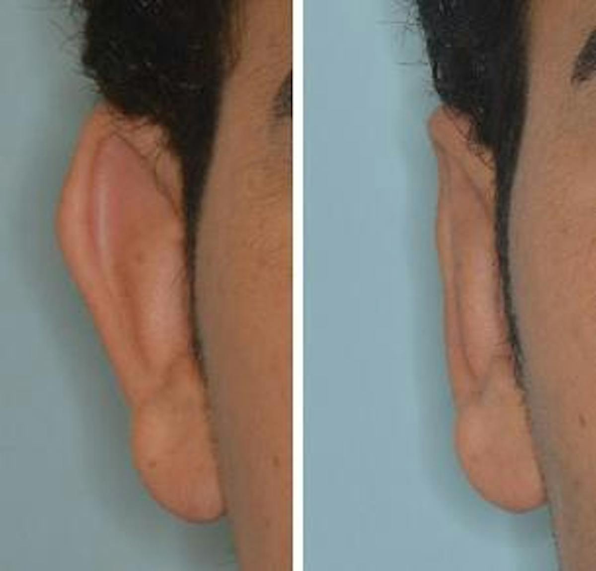 Otoplasty before and after, frontal. Frontal view of the right ear.