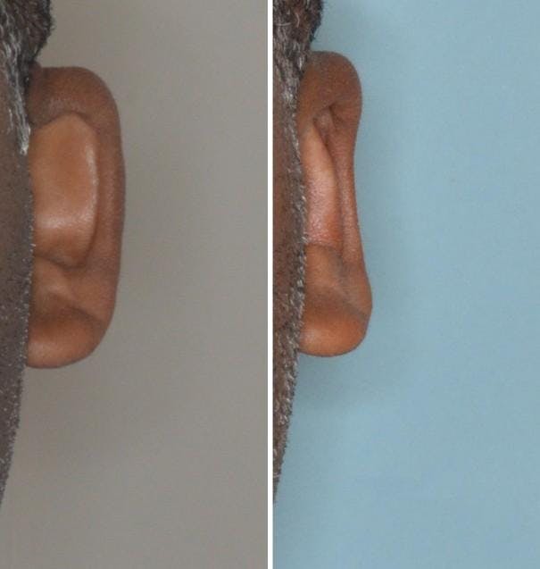 Otoplasty before and after, frontal. Frontal view of the left ear.