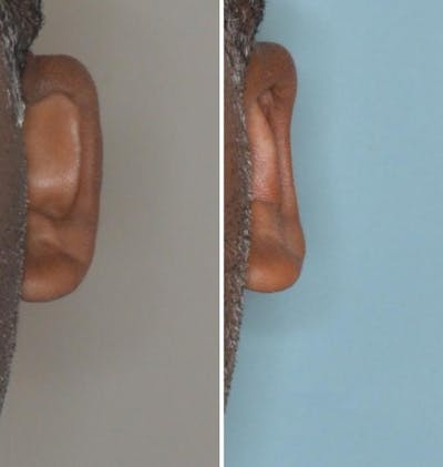 Otoplasty before and after, frontal. Frontal view of the left ear.