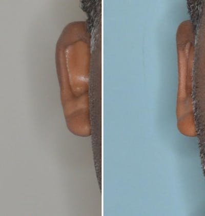 Otoplasty before and after, frontal. Frontal view of the right ear.