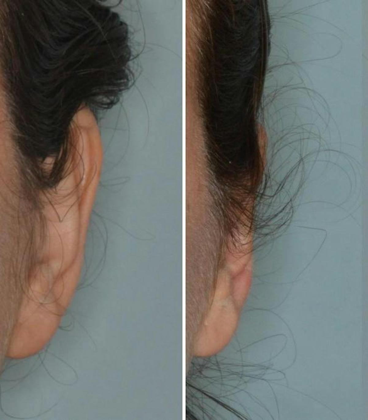 Otoplasty before and after, frontal. Frontal view of the left ear.