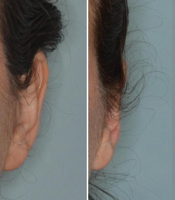 Otoplasty before and after, frontal. Frontal view of the left ear.