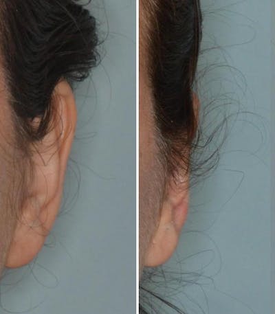 Otoplasty before and after, frontal. Frontal view of the left ear.