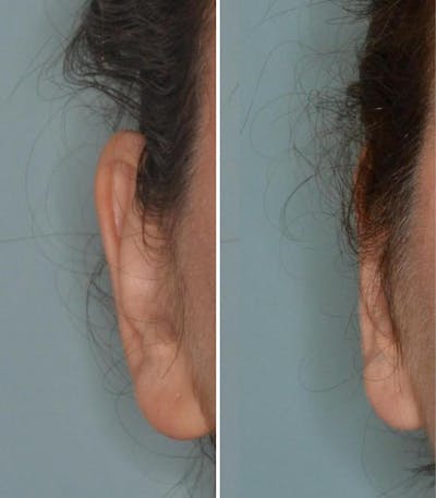 Otoplasty before and after, frontal. Frontal view of the right ear.