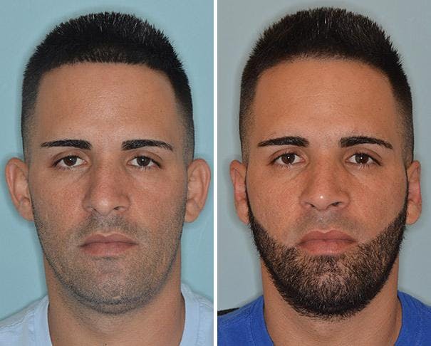 Otoplasty before and after, frontal.
