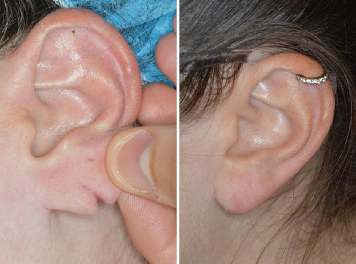 Earlobe Repair before and after, lateral left.