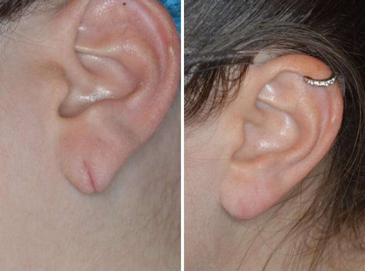 Earlobe Repair before and after, lateral left.