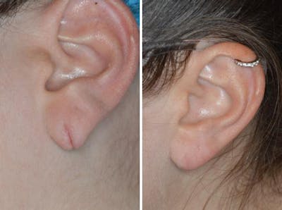 Earlobe Repair before and after, lateral left.