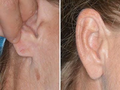 Earlobe Repair before and after, oblique right.