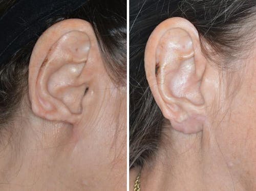 Earlobe Repair before and after, lateral right.