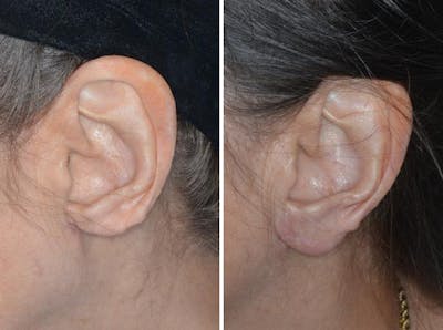 Earlobe Repair before and after, lateral left.