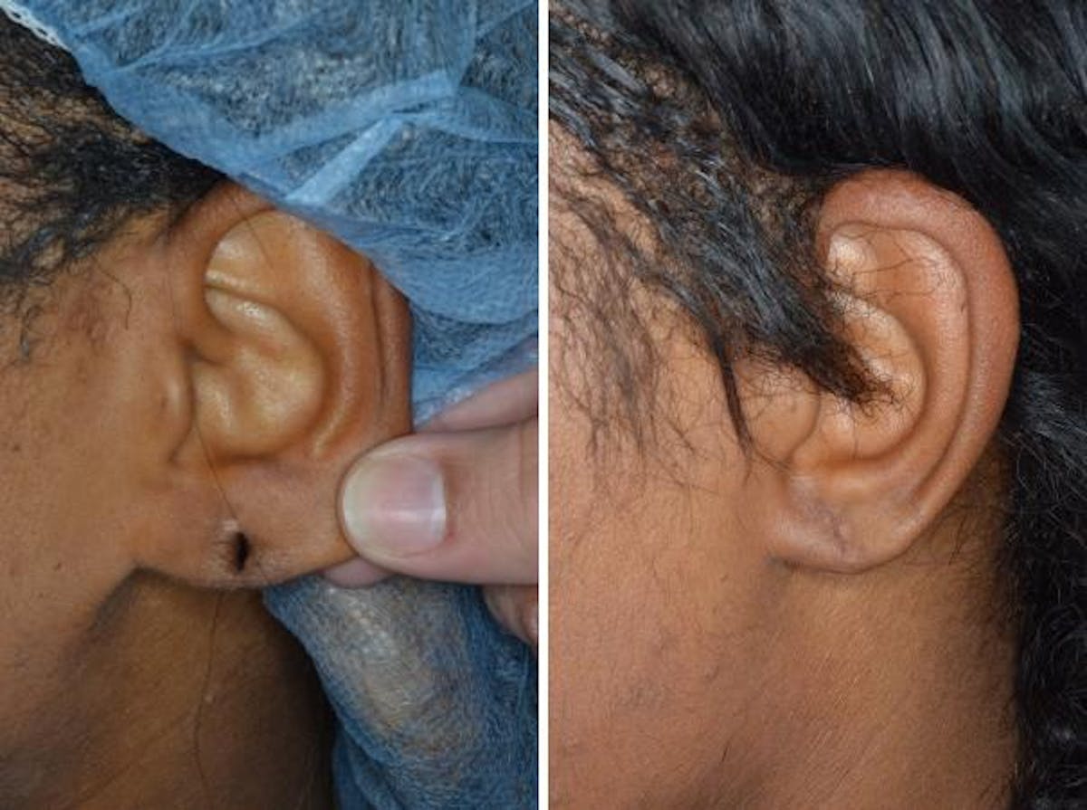 Earlobe Repair before and after, lateral left.