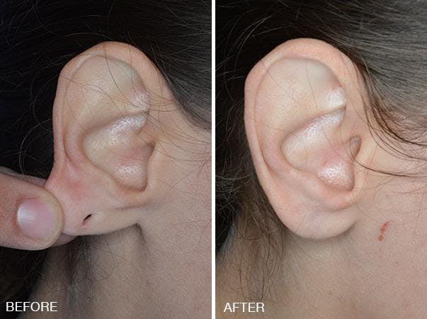 Earlobe Repair before and after, lateral right.