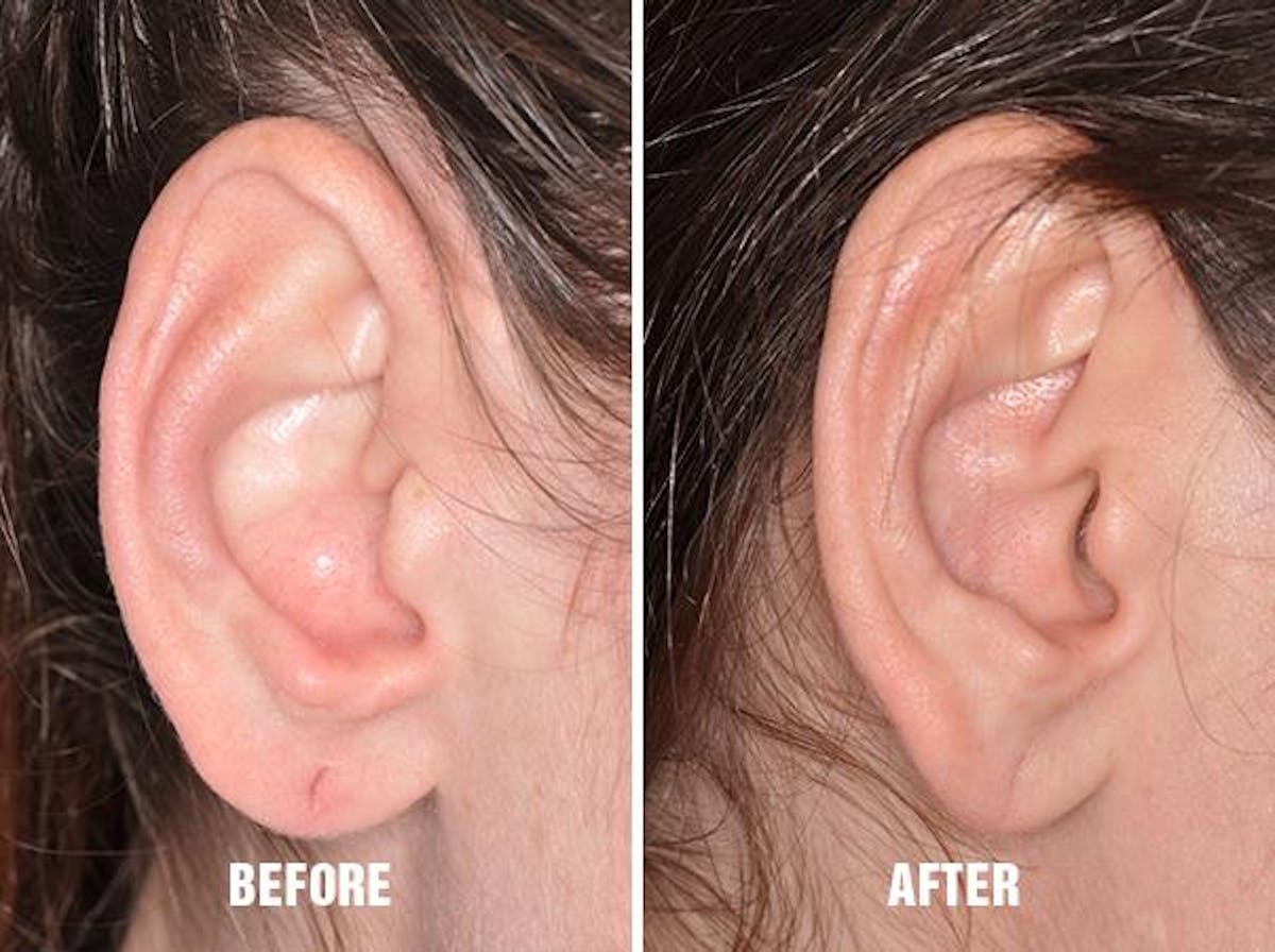 Earlobe Repair before and after, lateral right.