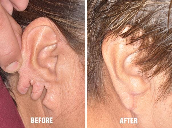 Earlobe Repair before and after, lateral right.