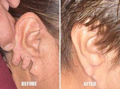 Earlobe Repair before and after, lateral right.