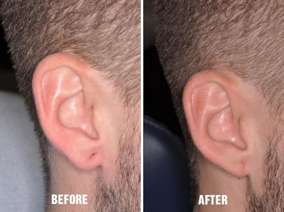 Earlobe Repair before and after, lateral right.