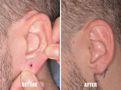 Earlobe Repair before and after, lateral left.