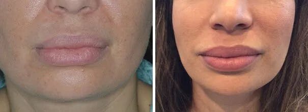 Lip Reduction before and after, frontal.