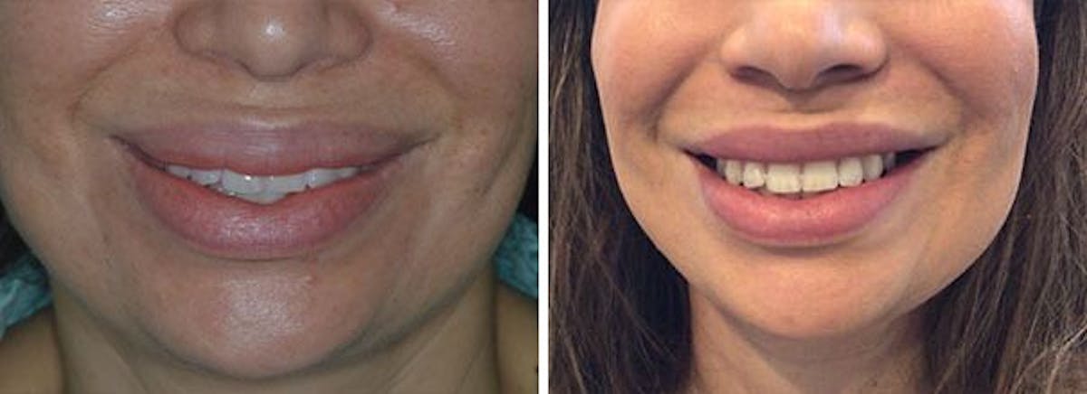 Lip Reduction before and after, frontal.