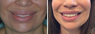 Lip Reduction before and after, frontal.