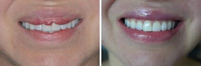 Lip Reduction before and after, frontal.