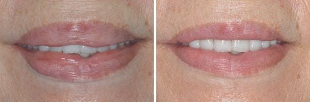 Lip Reduction before and after, frontal.