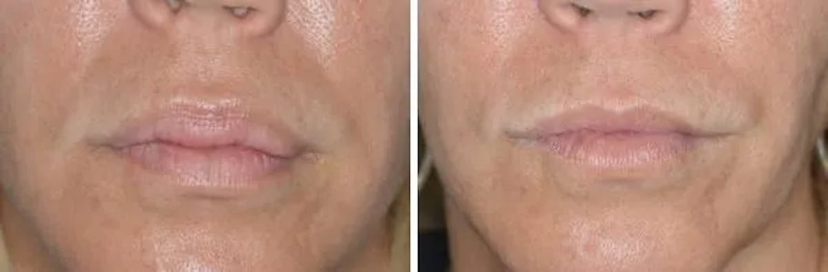 Lip Reduction before and after, frontal.