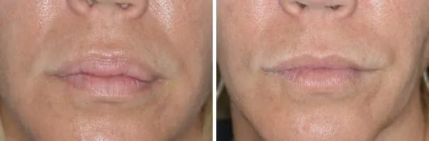Lip Reduction before and after, frontal.
