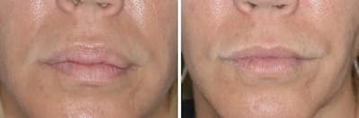 Lip Reduction before and after, frontal.