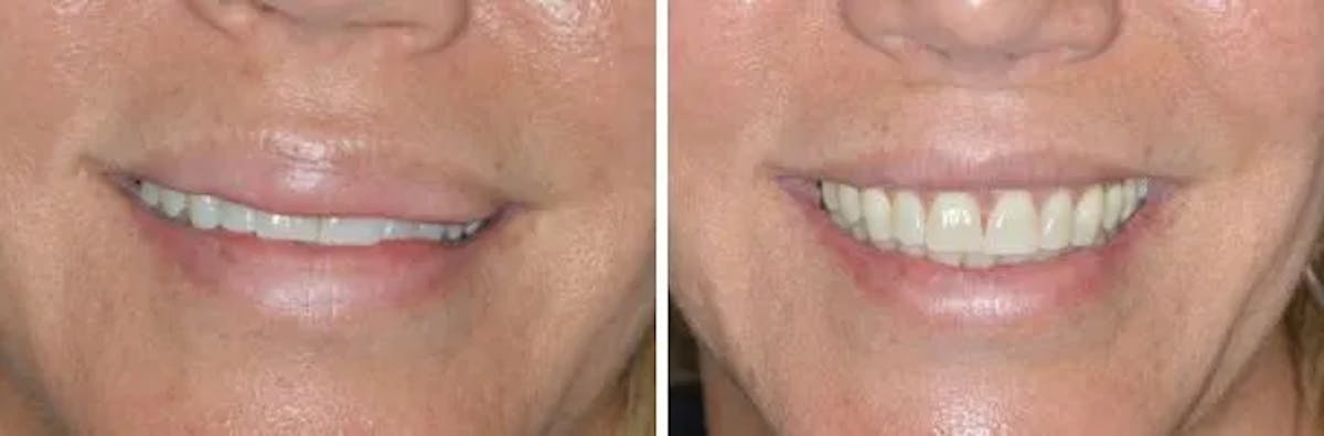 Lip Reduction before and after, frontal.