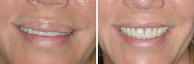 Lip Reduction before and after, frontal.