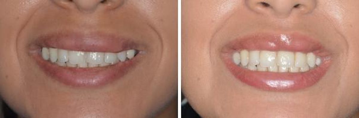 Lip Reduction before and after, frontal.