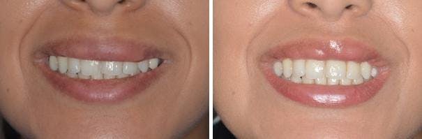 Lip Reduction before and after, frontal.