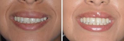 Lip Reduction before and after, frontal.