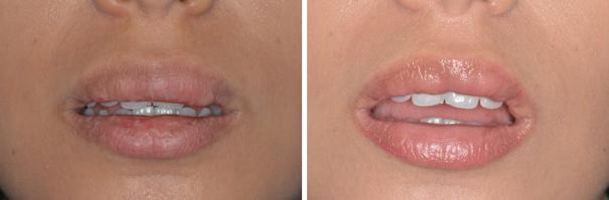 Lip Reduction before and after, frontal.