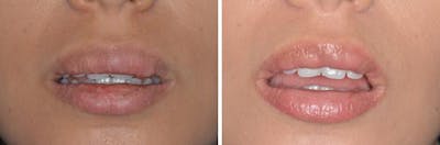 Lip Reduction before and after, frontal.