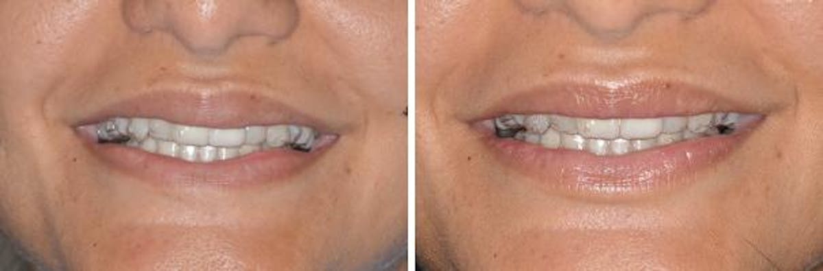 Lip Reduction before and after, frontal.
