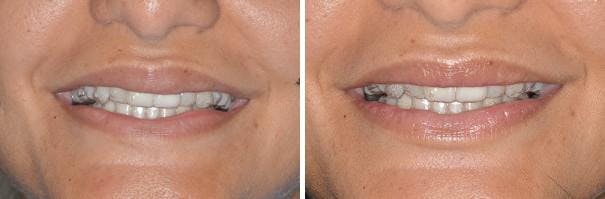 Lip Reduction before and after, frontal.