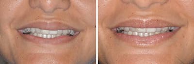 Lip Reduction before and after, frontal.