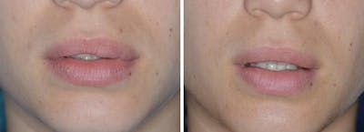 Lip Reduction before and after, frontal.