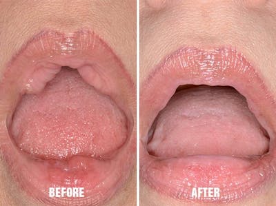 Lip Reduction before and after, frontal.