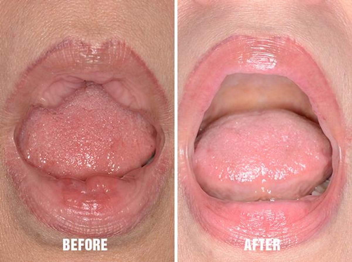 Lip Reduction before and after, frontal.
