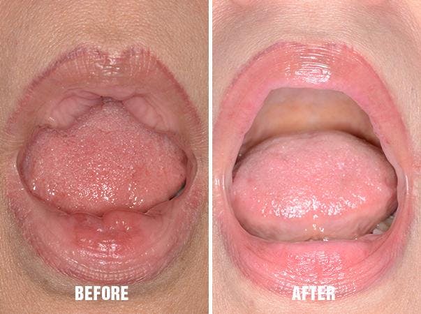 Lip Reduction before and after, frontal.
